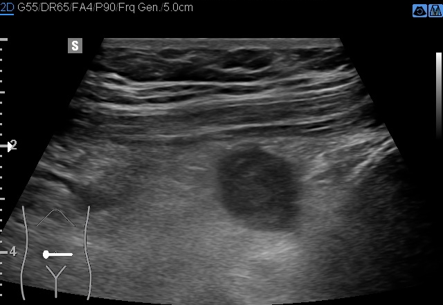 File:Acute appendicitis (Radiopaedia 85193-100745 D 182).jpg