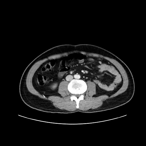 Acute appendicitis and COVID 19 pneumonia (Radiopaedia 76604-88380 Axial C+ portal venous phase 45).jpg