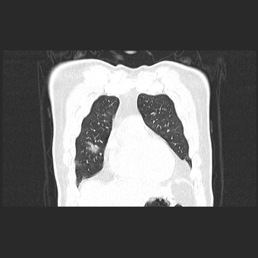 Acute appendicitis and COVID 19 pneumonia (Radiopaedia 76604-88380 G 16).jpg