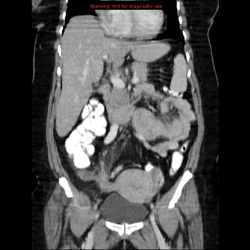 File:Acute appendicitis complicated by ovarian vein thrombophlebitis (Radiopaedia 16172-15851 Coronal C+ portal venous phase 37).jpg