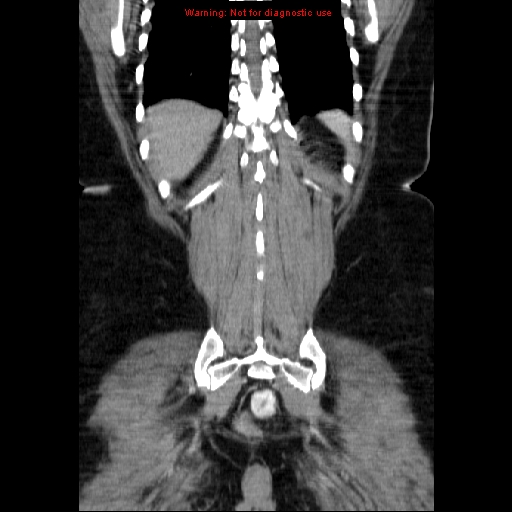 Acute appendicitis complicated by ovarian vein thrombophlebitis (Radiopaedia 16172-15851 Coronal C+ portal venous phase 68).jpg