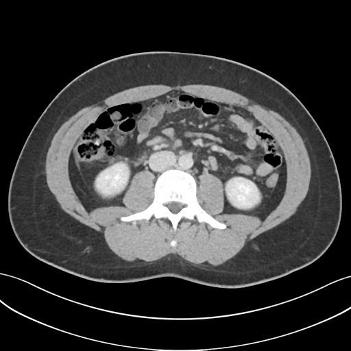 Acute appendicitis with appendicoliths (Radiopaedia 50186-55532 Axial C+ portal venous phase 41).png