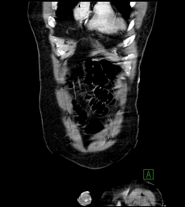 Acute arterial mesenteric ischemia (Radiopaedia 78238-90828 Coronal C+ portal venous phase 20).jpg