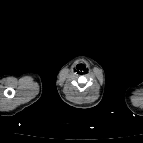 Acute aspiration pneumonitis (Radiopaedia 33605-34703 Axial non-contrast 1).jpg