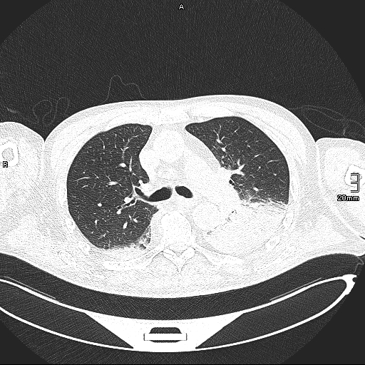 File:Acute aspiration pneumonitis (Radiopaedia 55642-62166 Axial lung window 64).jpg
