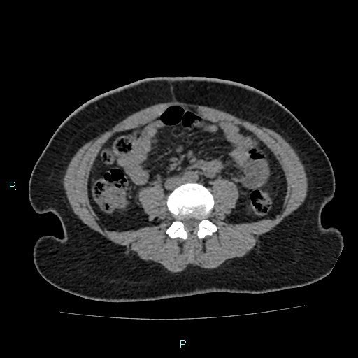Acute bilateral pyelonephritis (Radiopaedia 37146-38881 Axial non-contrast 64).jpg