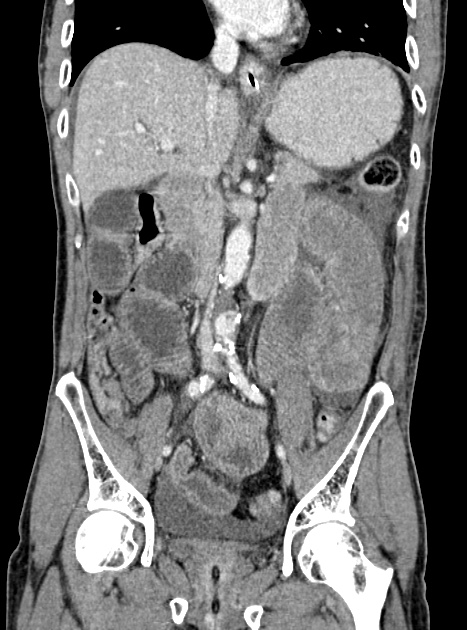 Acute bowel ischemia (Radiopaedia 87695-104114 Coronal C+ portal venous phase 205).jpg