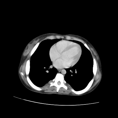 Acute calculous cholecystitis in patient with osteopetrosis (Radiopaedia 77871-90159 Axial C+ portal venous phase 9).jpg