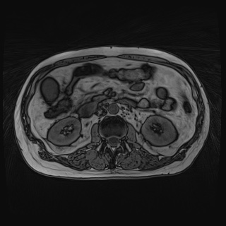 Acute cholecystitis (Radiopaedia 72392-82923 Axial T1 out-of-phase 69).jpg