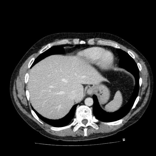 Acute cholecystitis and incidental left sided IVC (Radiopaedia 49352-54459 Axial C+ portal venous phase 30).jpg