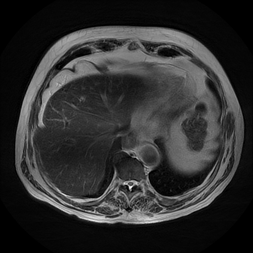 File:Acute cholecystitis complicated by pylephlebitis (Radiopaedia 65782-74915 Axial T2 7).jpg