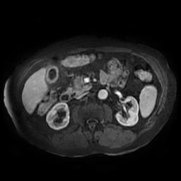 File:Acute cholecystitis complicated by pylephlebitis (Radiopaedia 65782-74915 Axial arterioportal phase T1 C+ fat sat 81).jpg