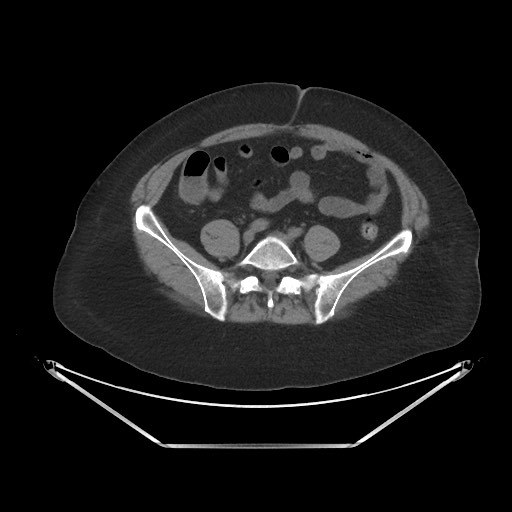 Acute cholecystitis with tensile fundus sign (Radiopaedia 71394-81723 Axial non-contrast 78).jpg