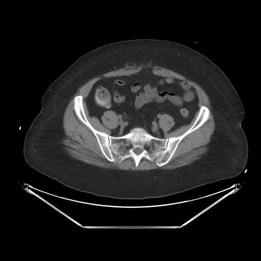 File:Acute cholecystitis with tensile fundus sign (Radiopaedia 71394-81723 Axial non-contrast 86).jpg