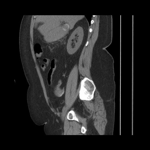 Acute cholecystitis with tensile fundus sign (Radiopaedia 71394-81723 Sagittal non-contrast 67).jpg