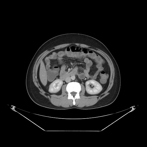 File:Acute complicated calculous cholecystitis (Radiopaedia 55202-61587 Axial C+ delayed 48).jpg