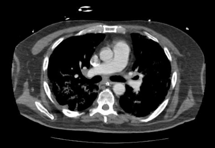 Acute cor pulmonale (ultrasound) (Radiopaedia 83508-98818 Axial C+ CTPA 33).jpg
