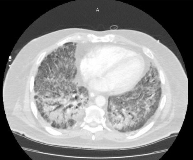 Acute cor pulmonale (ultrasound) (Radiopaedia 83508-98818 Axial lung window 60).jpg