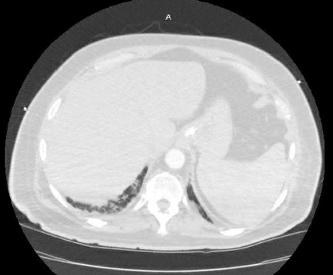 Acute cor pulmonale (ultrasound) (Radiopaedia 83508-98818 Axial lung window 83).jpg