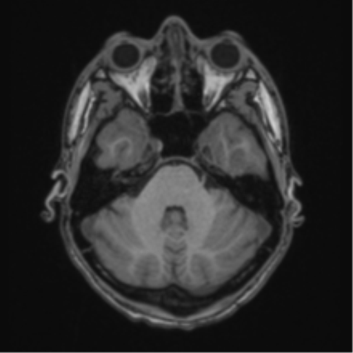 Acute disseminated encephalomyelitis (ADEM) (Radiopaedia 65319-74349 Axial T1 14).png