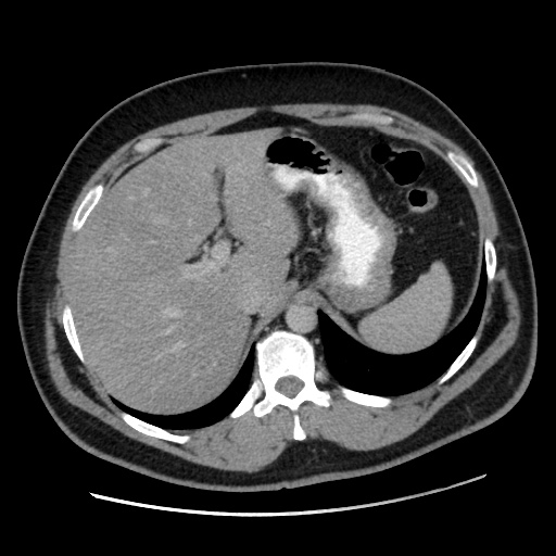 File:Acute diverticulitis with localized perforation (Radiopaedia 41296-44113 Axial C+ portal venous phase 21).jpg