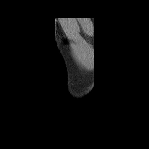 Acute epicardial fat necrosis (Radiopaedia 42327-45440 Sagittal C+ CTPA 2).jpg