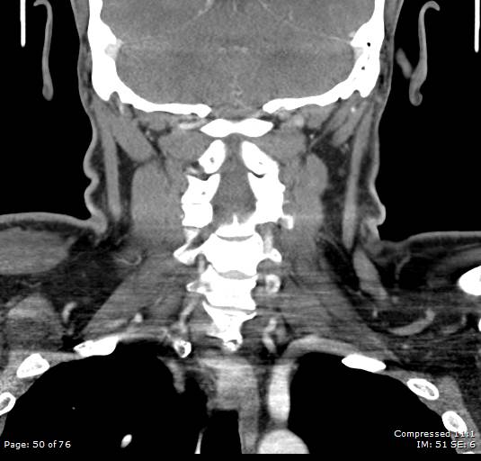 Acute epiglottitis (Radiopaedia 54375-60590 Coronal C+ arterial phase 50).jpg