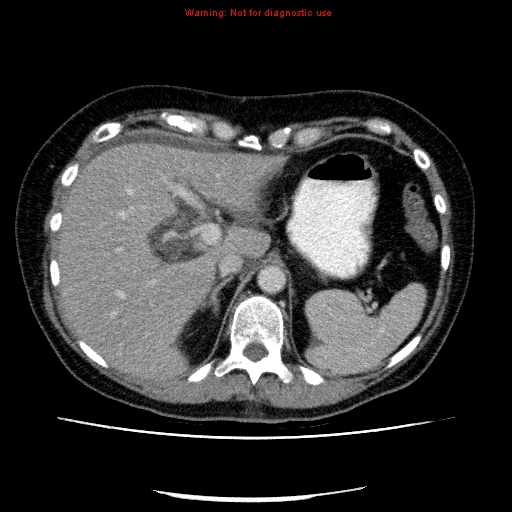 Acute gangrenous cholecystitis (Radiopaedia 10123-10661 Axial C+ portal venous phase 23).jpg