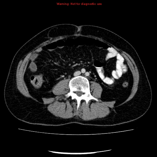 Acute gangrenous cholecystitis (Radiopaedia 10123-10661 Axial C+ portal venous phase 61).jpg