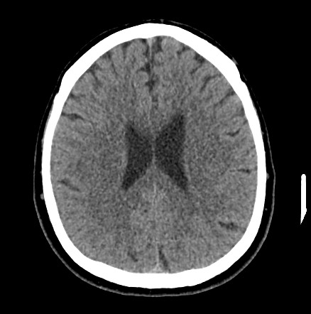 Acute internal carotid artery dissection (Radiopaedia 53541-59558 Axial non-contrast 39).jpg