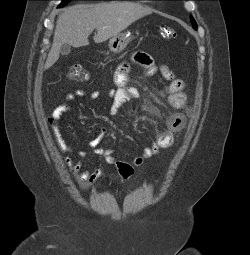 Acute mesenteric venous ischemia (Radiopaedia 46041-50383 Coronal C+ portal venous phase 26).jpg