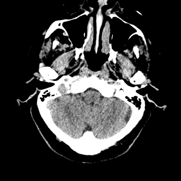 Acute middle cerebral artery territory infarct (Radiopaedia 52380-58283 Axial non-contrast 13).jpg