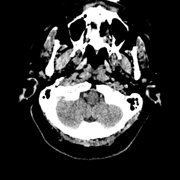 Acute middle cerebral artery territory infarct (Radiopaedia 52380-58283 Axial non-contrast 6).jpg