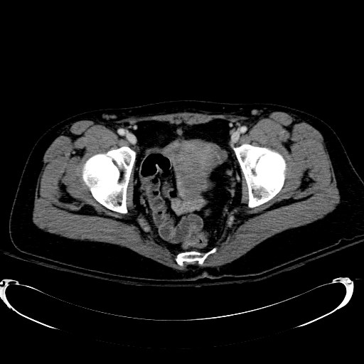 Acute myocardial infarction in CT (Radiopaedia 39947-42415 Axial C+ portal venous phase 123).jpg