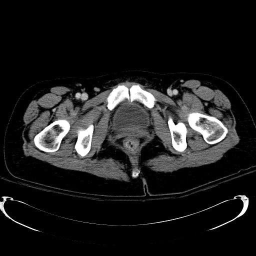 Acute myocardial infarction in CT (Radiopaedia 39947-42415 Axial C+ portal venous phase 136).jpg