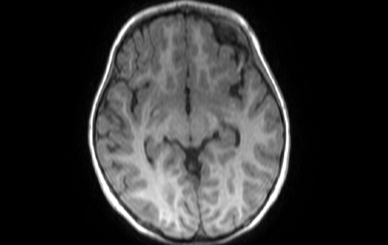 File:Acute necrotizing encephalitis of childhood (Radiopaedia 67356-76737 Axial T1 54).jpg