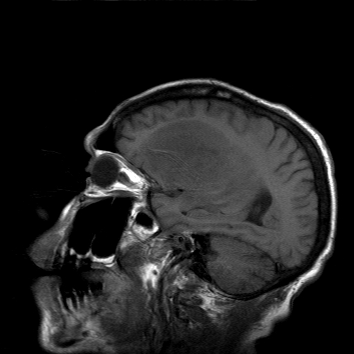 File:Acute necrotizing toxoplasma encephalitis (Radiopaedia 10683-11149 Sagittal T1 fat sat 6).jpg