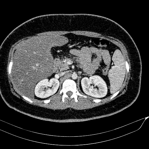 Acute on chronic pancreatitis (Radiopaedia 80902-94423 Axial C+ portal venous phase 59).jpg