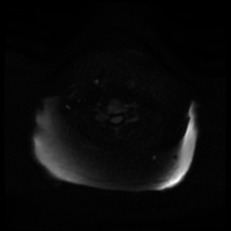 Acute otitis externa (Radiopaedia 57296-64236 Axial DWI 25).jpg