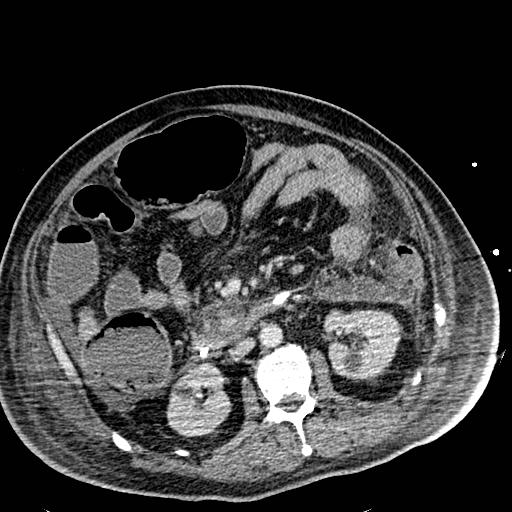 Acute pancreatic necrosis (Radiopaedia 13560-18501 Axial C+ portal venous phase 67).jpg