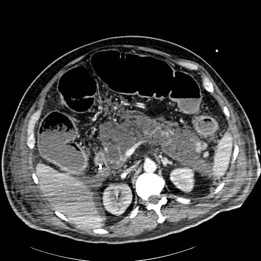 File:Acute pancreatic necrosis (Radiopaedia 13560-18502 Axial C+ portal venous phase 27).jpg