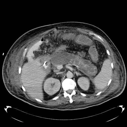 Acute pancreatic necrosis (Radiopaedia 13560-18503 Axial C+ portal venous phase 25).jpg