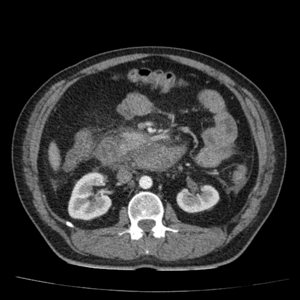 Acute pancreatitis (Radiopaedia 26663-26813 Axial C+ arterial phase 46).jpg