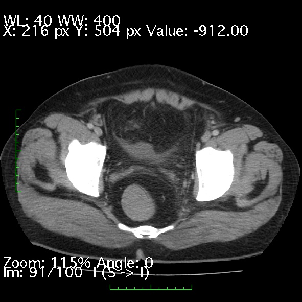 Acute pancreatitis (Radiopaedia 34043-35276 Axial C+ portal venous phase 91).jpg
