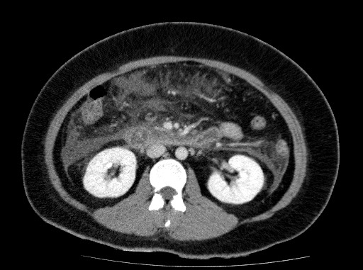 Acute pancreatitis (Radiopaedia 69236-79012 Axial C+ portal venous phase 42).jpg