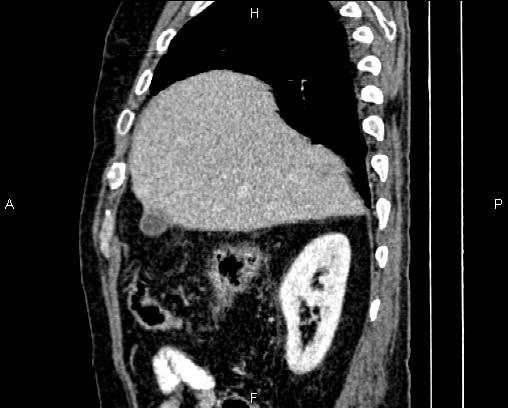 Acute pancreatitis (Radiopaedia 85146-100701 Sagittal C+ portal venous phase 19).jpg