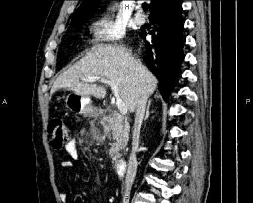 Acute pancreatitis (Radiopaedia 85146-100701 Sagittal C+ portal venous phase 37).jpg
