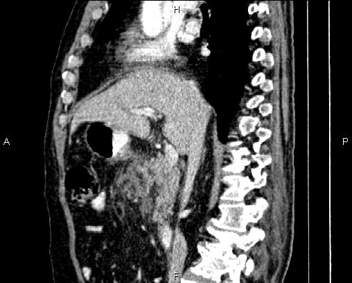 Acute pancreatitis (Radiopaedia 85146-100701 Sagittal C+ portal venous phase 39).jpg
