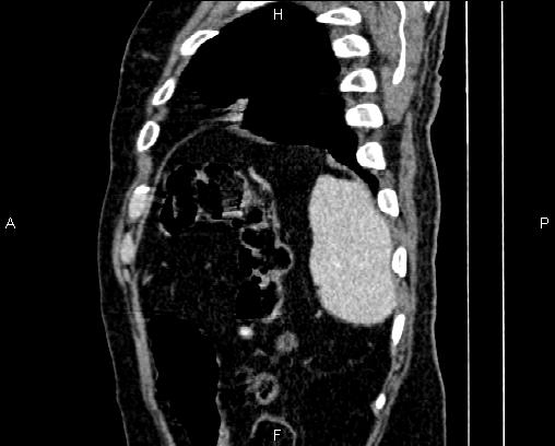 Acute pancreatitis (Radiopaedia 85146-100701 Sagittal C+ portal venous phase 84).jpg