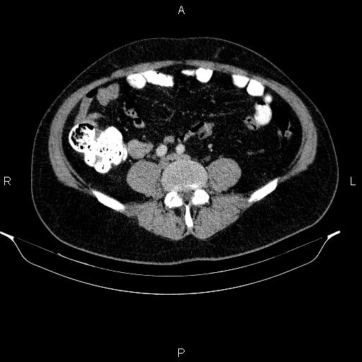 Acute pancreatitis (Radiopaedia 85390-101010 Axial C+ portal venous phase 71).jpg